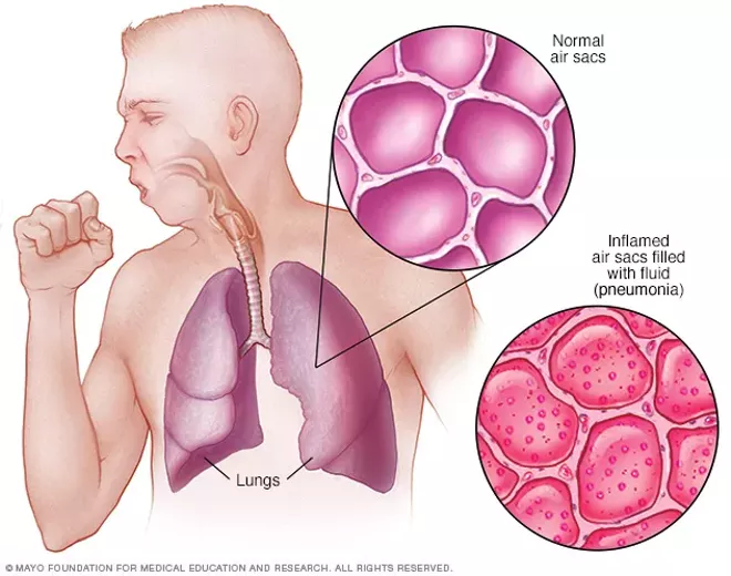 Facts about pneumonia in adults