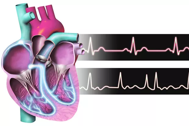 The heart "remodeling" itself to be more efficient can be a good and bad thing, according to a local doctor. - WIKIMEDIA COMMONS