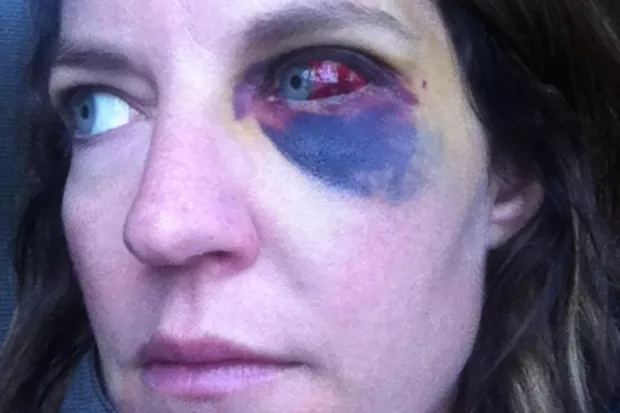 Katie Dailey's injuries after being punched by a Bend police officer. Her left lateral orbital bone, along with her left inferior orbital bone, were both broken. - COURTESY KATIE DAILEY