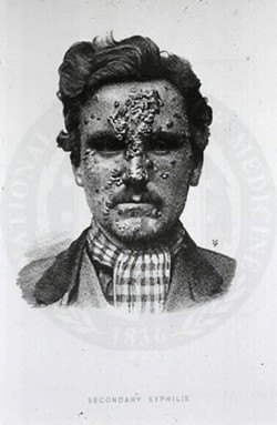 NATIONAL LIBRARY OF MEDICINE - Syphilis was once a debilitating disease that left sufferers disfigured and even dead. Antibiotics today mean the disease is easily treated.