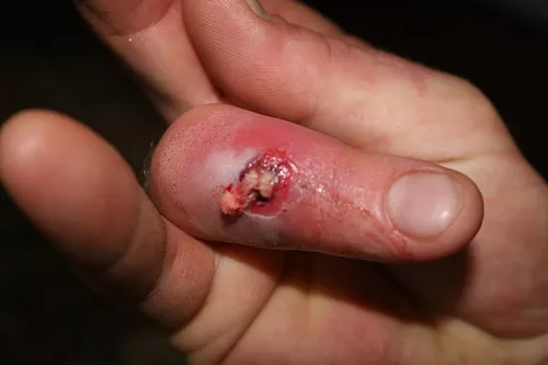 This MRSA boil began with a splinter.