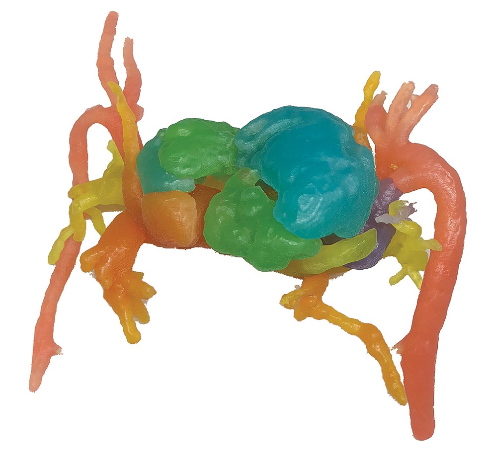 Model of the hearts of conjoined twins, with color-coding to show each of the heart chambers and aortas, 3D-printed by Mediprint for presurgical planning.