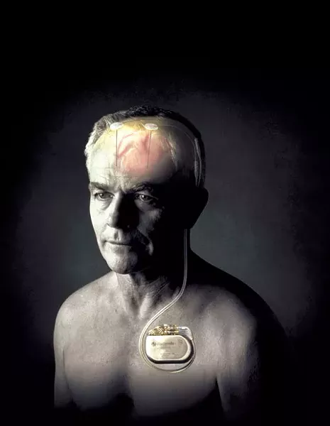 Tiny electrodes implanted in a patient's brain, attached to a pacemaker, can reduce or eliminate tremors.