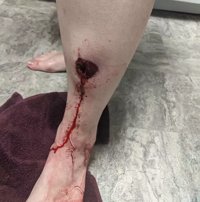 The pain from the damage one rubber bullet did to Jessie Lewis's leg caused her to pass out. - COURTESY JESSIE LEWIS