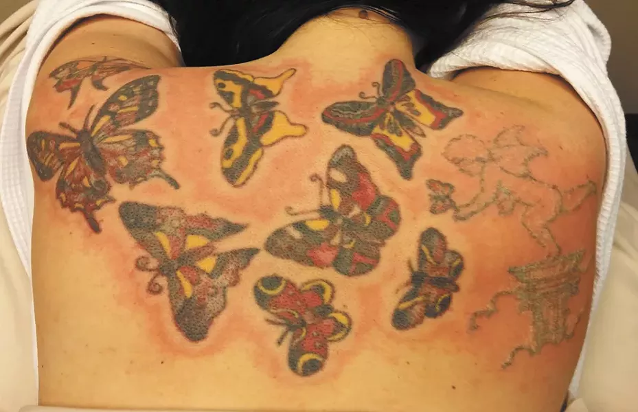 A patient getting started on the process of tattoo removal. - ADVANCED AESTHETICS PHOTO