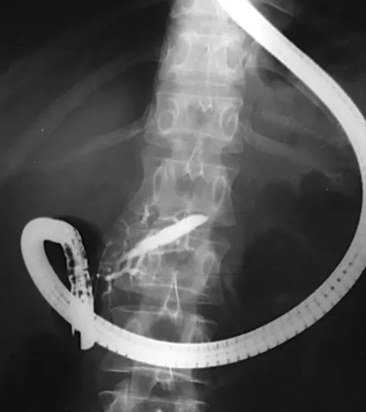 Fluoroscopic image taken during an endoscopic examination