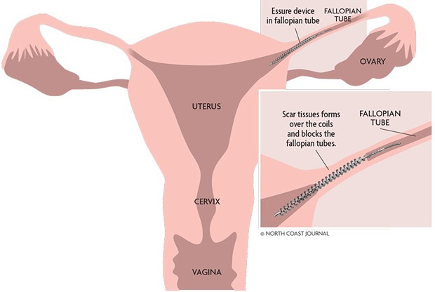 An illustration of how Essure is supposed to work. - NORTH COAST JOURNAL GRAPHIC
