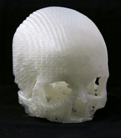 SKULL AND BONES:  The actual 3-D printed models of Scott&rsquo;s skull revealed the location and detail of her tumor with more precision than the MRIs and CT scans. - IMAGE COURTESY OF MICHAEL BALZER
