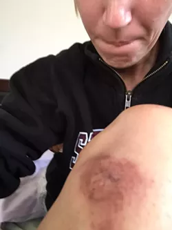AFTERMATH: Grover Beach resident Andrea Hansen, who has epilepsy, claims she sustained this and other injuries in a scuffle with police that occurred when she was arrested after calling 911 to report that she was having multiple seizures. - PHOTO COURTESY OF GOFUNDME
