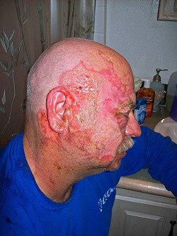SULFUR BURNS :  Steve Swader survived a blast of sulfur to his face, neck, and hands in 2008 and credits the onsite health and safety shift specialist team with his quick recovery. - PHOTOS COURTESY OF STEVEN SWADER