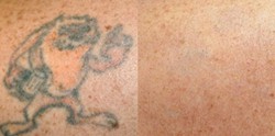 DISAPPEARING ACT:  Open Canvas Tattoo Removal uses the latest laser technology to break down ink on the outer layer of skin. - PHOTO COURTESY OF OPEN CANVAS