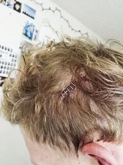 BLOOD AND STAPLES: “John” provided this photo, taken the day after a fight in which he sustained injuries—he believes at the hands of members of the Cal Poly wrestling team. The school’s official word after an investigation was that the “responsible party” was probably not a Cal Poly student or wrestler. - COURTESY PHOTO
