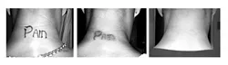 DISAPPEARING INK : Seth Souza has undergone nine laser treatments to have his tattoo removed. The process pictured here took from spring of 2004 to December 2005. He has got one treatment left. - PHOTOS COURTESY OF SETH SOUZA
