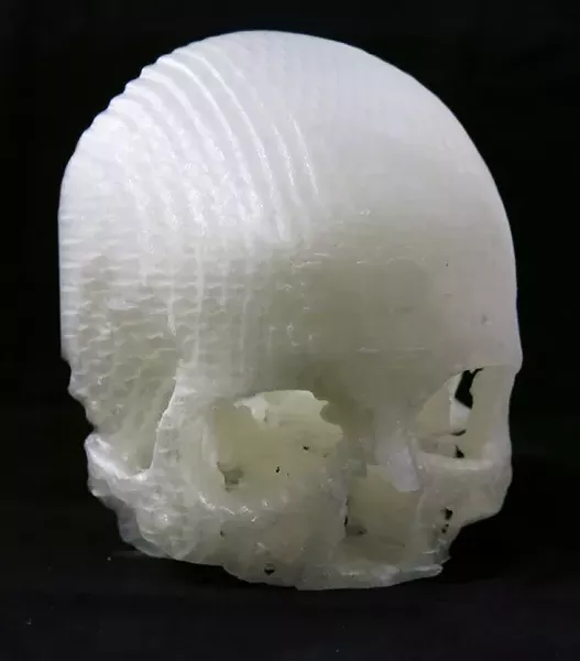SKULL AND BONES: The actual 3-D printed models of Scott’s skull revealed the location and detail of her tumor with more precision than the MRIs and CT scans. - IMAGE COURTESY OF MICHAEL BALZER
