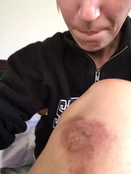 AFTERMATH: Grover Beach resident Andrea Hansen, who has epilepsy, claims she sustained this and other injuries in a scuffle with police that occurred when she was arrested after calling 911 to report that she was having multiple seizures. - PHOTO COURTESY OF GOFUNDME