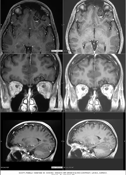 HEAD CASE: A series of Scott’s MRIs revealed a mass behind her left eye known as a meningioma—a benign tumor. - IMAGE COURTESY OF MICHAEL BALZER