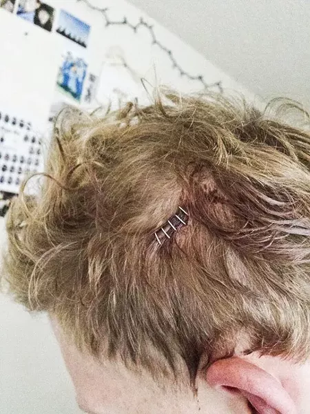 BLOOD AND STAPLES: “John” provided this photo, taken the day after a fight in which he sustained injuries—he believes at the hands of members of the Cal Poly wrestling team. The school’s official word after an investigation was that the “responsible party” was probably not a Cal Poly student or wrestler. - COURTESY PHOTO