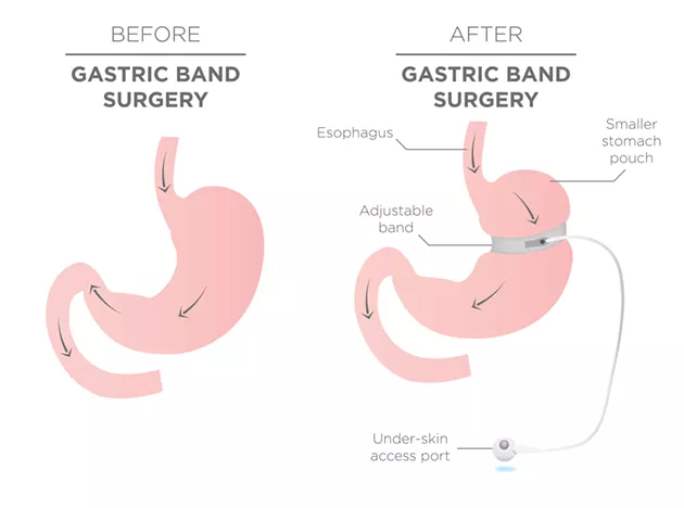 Before and After Gastric Band for Weight Loss - BIGSTOCK