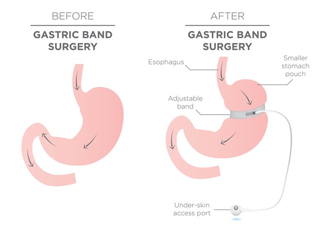 Before and After Gastric Band for Weight Loss - BIGSTOCK