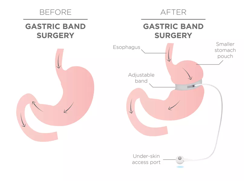 Before and After Gastric Band for Weight Loss - BIGSTOCK