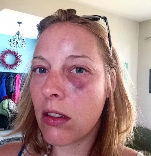 Megan Rieke was left bruised after a run-in with an angry Crestwood cop, her lawyer says. - COURTESY OF JAMES BRADY