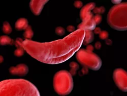 People with sickle cell anemia have abnormally shaped blood cells, which can contribute to a number of health conditions and risks. - FILE PHOTO