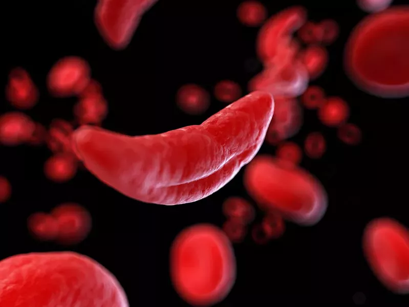 People with sickle cell anemia have abnormally shaped blood cells, which can contribute to a number of health conditions and risks. - FILE PHOTO