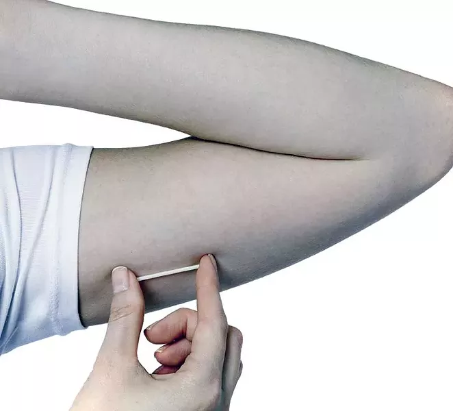 Birth control implant