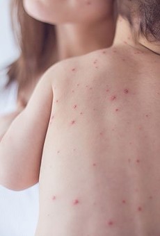 First Measles Case Reported in San Antonio by University Health System