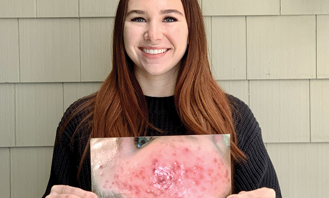 Skin Spa Utah acne treatment - COURTESY PHOTO