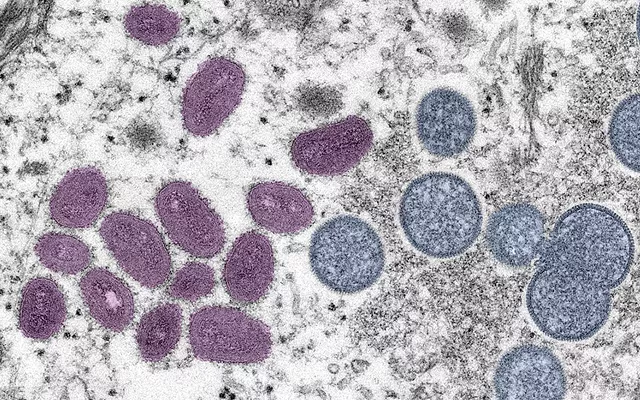 An illustration of the monkeypox virus - COURTESY OF THE CENTERS FOR DISEASE CONTROL AND PREVENTION