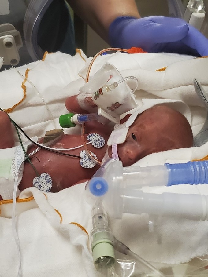 “I have never seen something so beautiful, small and fragile in my whole life,” Kyle, Henry's father, said. “I felt overwhelmed with emotion in that moment…gratitude, a sense of miracle, relief and sheer terror all at the same time. I’ve never cried so much in my whole life as I have this week. We just want our baby to live.” - TUCSON MEDICAL CENTER